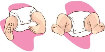 Medical illustration comparing baby with club foot and normal foot position