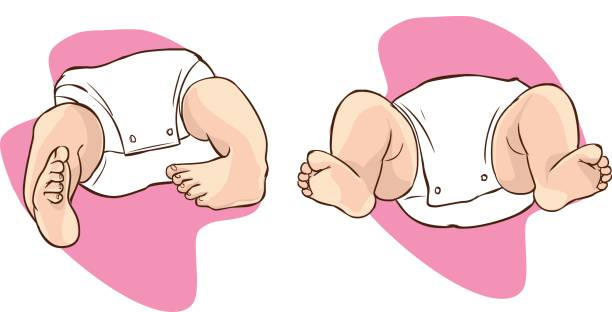 Medical illustration comparing baby with club foot and normal foot position