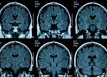 MRI brain scans used to rule out underlying causes of cluster headaches