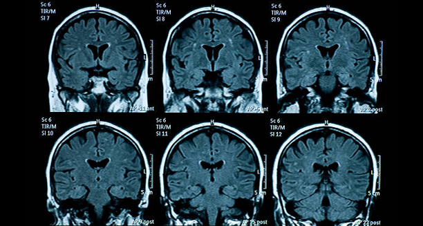 MRI brain scans used to rule out underlying causes of cluster headaches