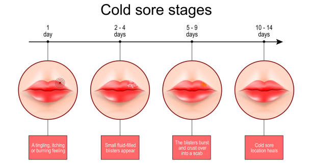 Cold sore development stages on lips over 14 days