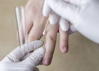 Medical professional performing a skin swab test on a patient's hand to diagnose contact dermatitis.