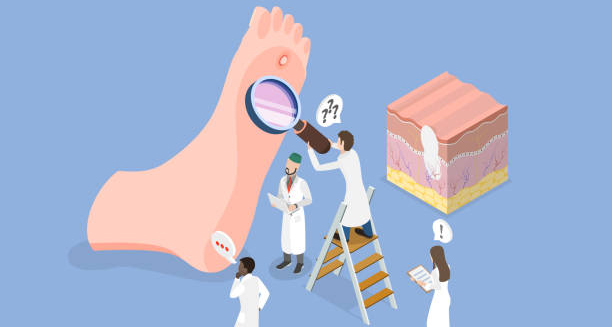 Illustration of doctors examining a foot with a magnifying glass to diagnose a corn, alongside a cross-section of skin.