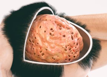 Illustration of a brain with visible atrophy and lesions, symbolising neurological damage from corticobasal degeneration.