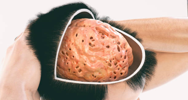 Illustration of a brain with visible atrophy and lesions, symbolising neurological damage from corticobasal degeneration.