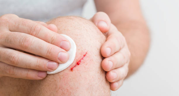 Person cleaning a bleeding cut on their knee with a cotton pad.