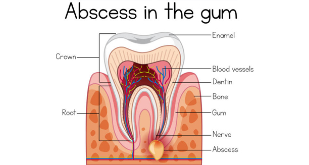 Cross-section diagram showing abscess in the gum beneath a tooth