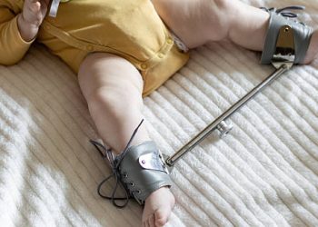 Infant wearing a Pavlik harness for hip dysplasia treatment