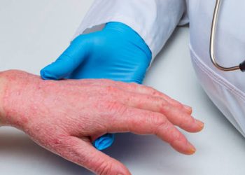 Doctor examining a patient’s inflamed hand for diagnosis of discoid eczema
