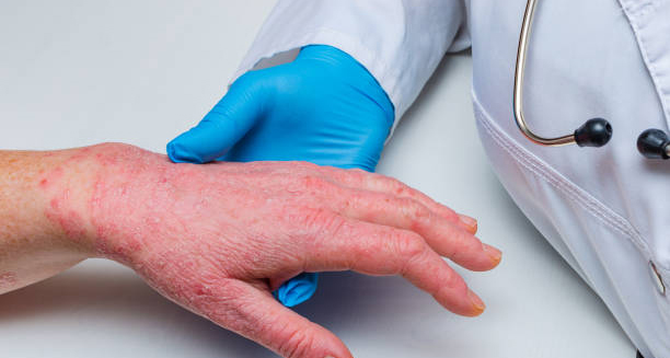 Doctor examining a patient’s inflamed hand for diagnosis of discoid eczema