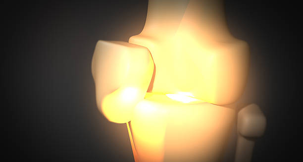 3D medical illustration showing dislocated kneecap in glowing joint anatomy