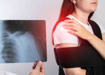 X-ray diagnosis of dislocated shoulder with woman wearing a shoulder brace