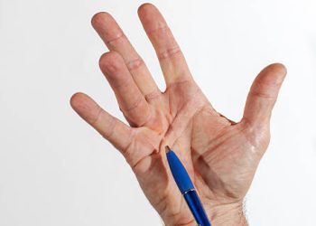 Hand showing visible cords in the palm during diagnosis of Dupuytren’s contracture