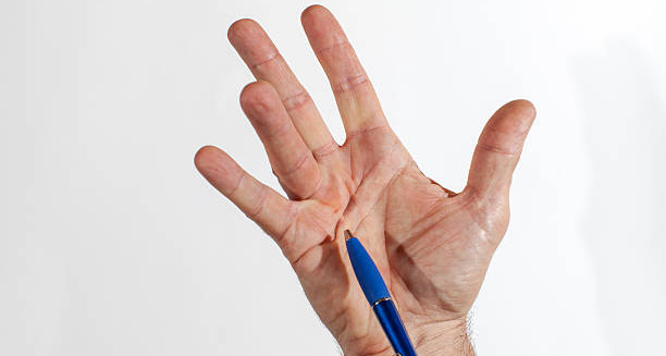 Hand showing visible cords in the palm during diagnosis of Dupuytren’s contracture