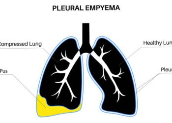 Diagnosis of Empyema