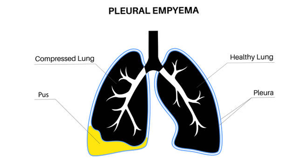 Diagnosis of Empyema