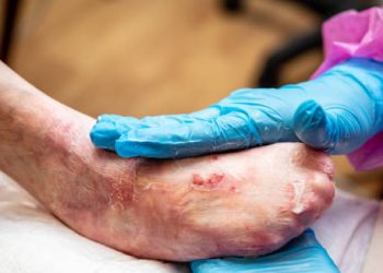 Medical professional examining blistered foot for Epidermolysis Bullosa diagnosis