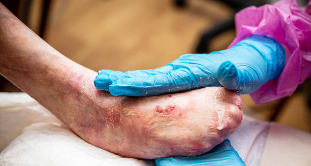 Medical professional examining blistered foot for Epidermolysis Bullosa diagnosis