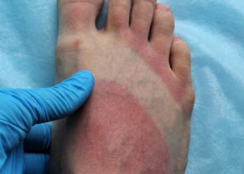 Medical professional examining red, inflamed foot consistent with erythromelalgia symptoms