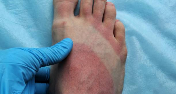 Medical professional examining red, inflamed foot consistent with erythromelalgia symptoms