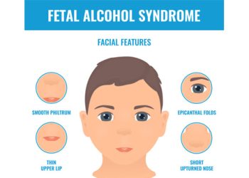 Facial features used to diagnose Fetal Alcohol Spectrum Disorder