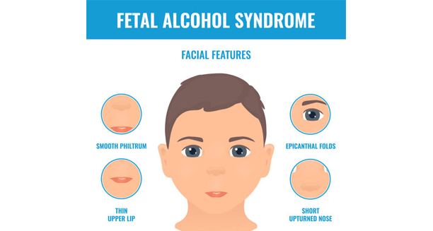 Facial features used to diagnose Fetal Alcohol Spectrum Disorder
