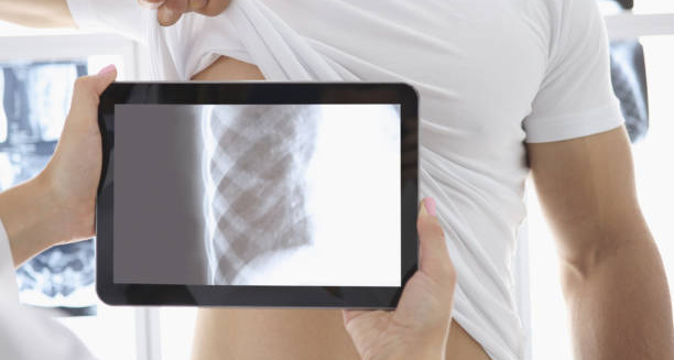 Doctor holding a tablet displaying a rib X-ray in front of a patient’s side, indicating cracked rib diagnosis.