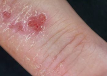 Close-up of red inflamed discoid eczema patch on the wrist