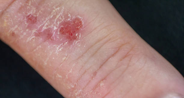 Close-up of red inflamed discoid eczema patch on the wrist