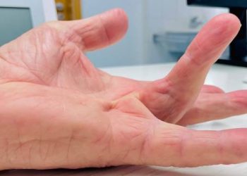Hand affected by Dupuytren’s contracture with bent finger and tightened tissue