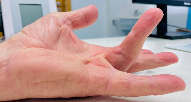 Hand affected by Dupuytren’s contracture with bent finger and tightened tissue