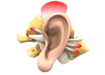 3D anatomical model illustrating a burst eardrum and inner ear structures
