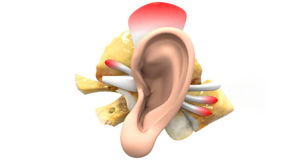 3D anatomical model illustrating a burst eardrum and inner ear structures