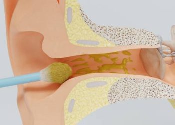 3D illustration of cotton bud pushing earwax deeper into the ear canal