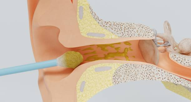 3D illustration of cotton bud pushing earwax deeper into the ear canal