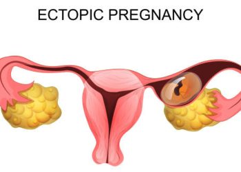 Ectopic Pregnancy