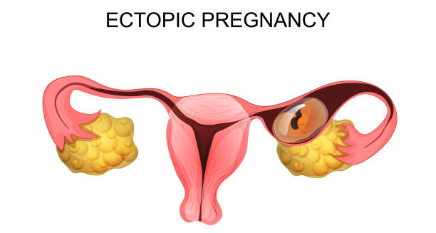 Ectopic Pregnancy