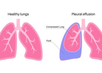 Diagram comparing healthy lungs and pleural effusion in empyema