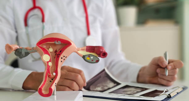 Gynaecologist showing female reproductive anatomy model with signs of endometriosis