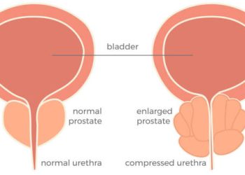 Medical diagram comparing a normal prostate and an enlarged prostate