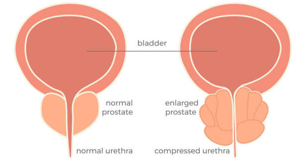 Medical diagram comparing a normal prostate and an enlarged prostate