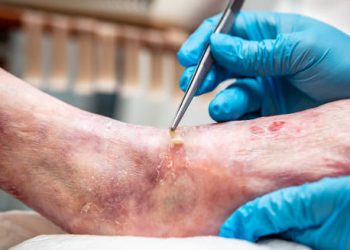 Close-up of wound care on a leg with Epidermolysis Bullosa.
