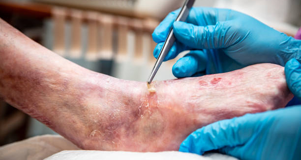 Close-up of wound care on a leg with Epidermolysis Bullosa.