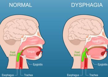 Medical diagram comparing normal swallowing and dysphagia related to epiglottitis