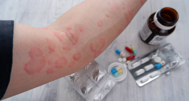 Forearm with red circular lesions from erythema multiforme next to various medications
