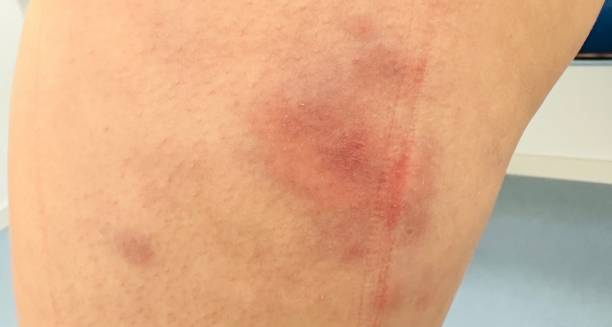 Red swollen patches on skin caused by erythema nodosum