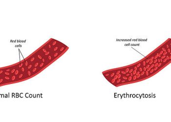 Comparison diagram showing normal red blood cell count versus erythrocytosis