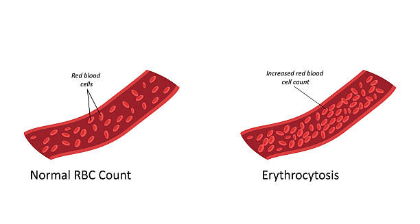 Comparison diagram showing normal red blood cell count versus erythrocytosis