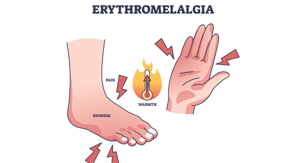 Illustration showing symptoms of erythromelalgia in hands and feet