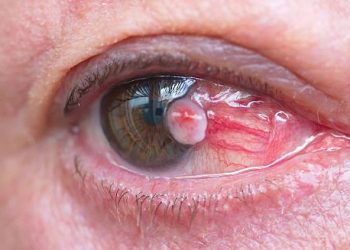 Close-up of eye showing visible tumour from eye cancer